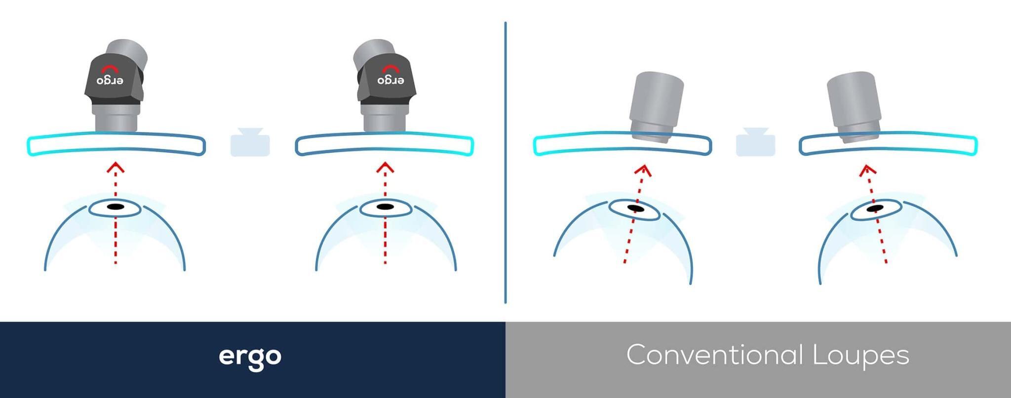 Ergo Loupes the future of dental ergonomics is now ADMETEC